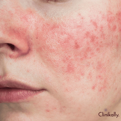 Chemical sunscreen and long-term skin health