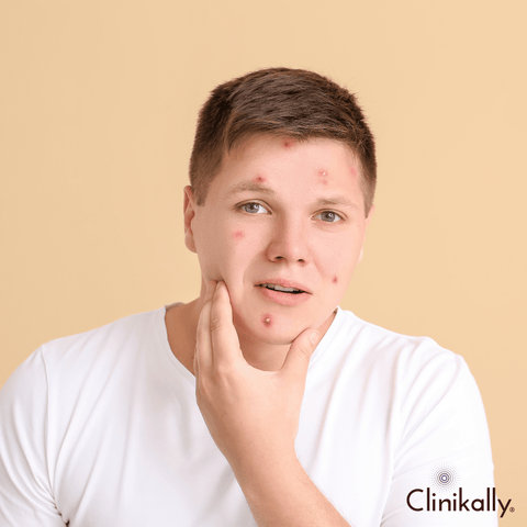 Retinol for Acne