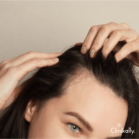 How Does Ketoconazole Shampoo Work?