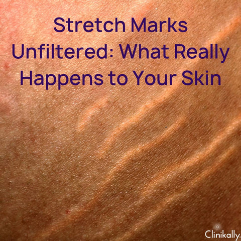 Stretch Marks Unfiltered: What Really Happens to Your Skin