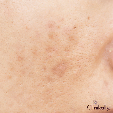 Retinol for dark spots