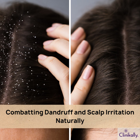Combatting Dandruff and Scalp Irritation Naturally