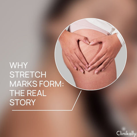 Why Stretch Marks Form: The Real Story