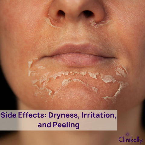 Side Effects of combining Retinol and Salicylic Acid