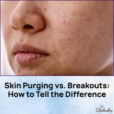 Difference Between Skin Purging and Breakouts