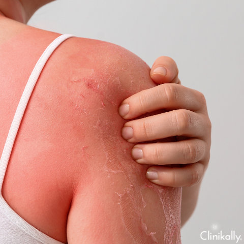 Laundry detergent breakouts