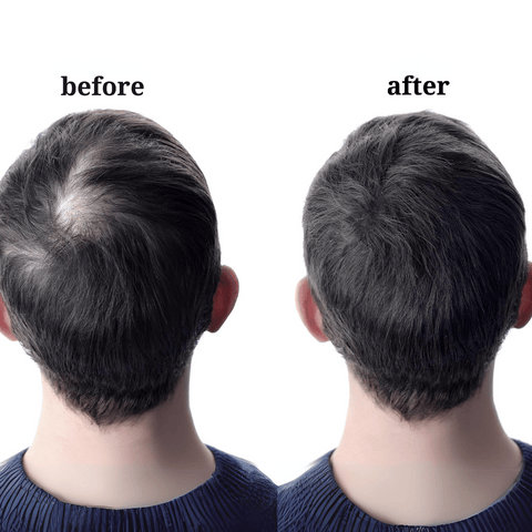 How do You deal with Alopecia Areata?
