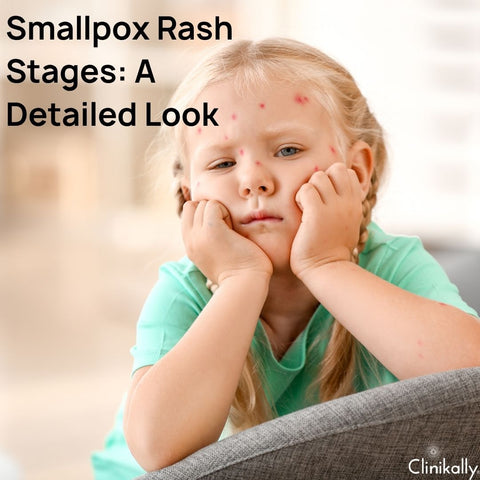 Smallpox Rash Stages: A Detailed Look