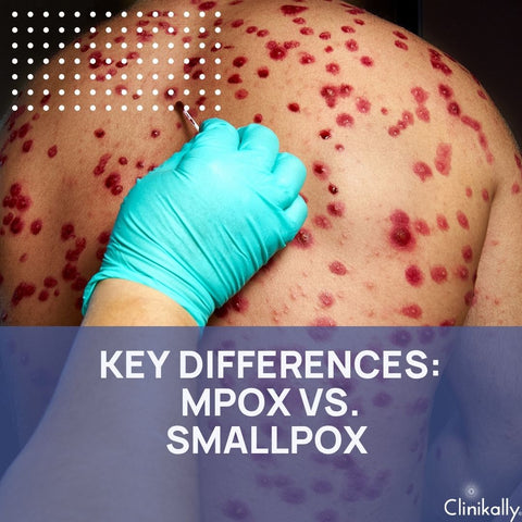 Key Differences: Mpox vs. Smallpox