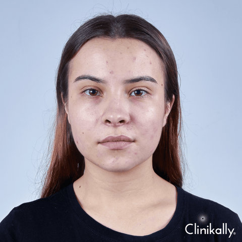 Retinol for Oily skin