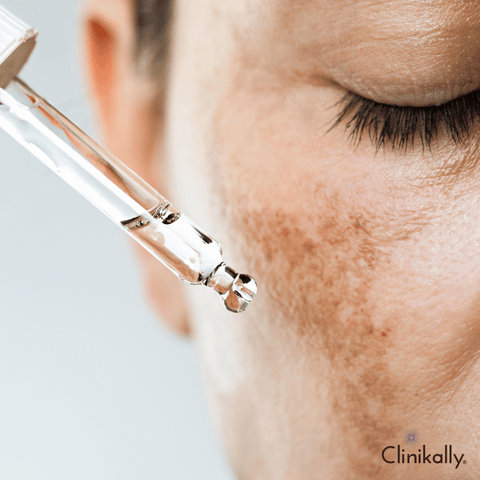 Alpha Arbutin for Melasma and Uneven Skin Tone
