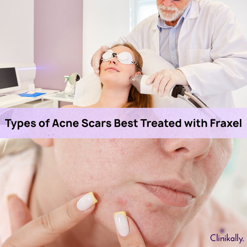 Types of Acne Scars Best Treated with Fraxel