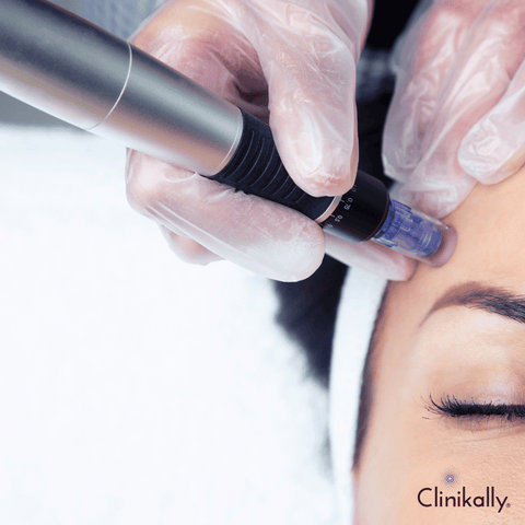 Microneedling: Stimulating skin to heal itself