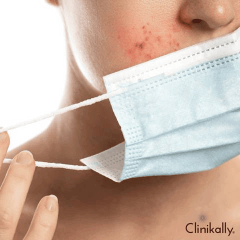 The science behind mask-induced breakouts