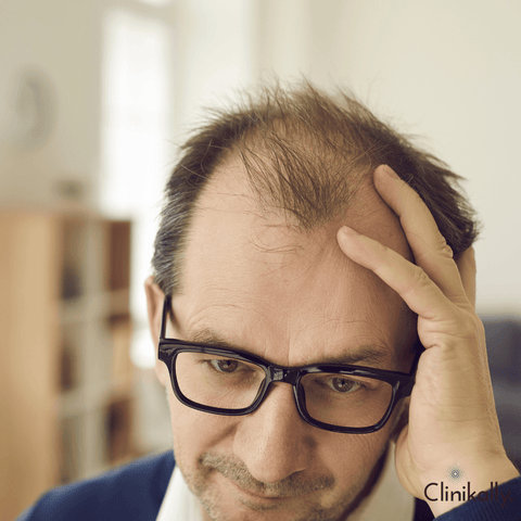 How to stop Alopecia Areata from spreading