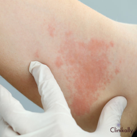 welts on skin