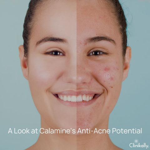 A Look at Calamine's Anti-Acne Potential