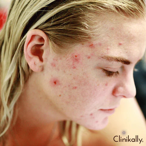 What causes acne?