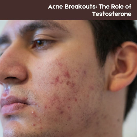 Acne Breakouts: The Role of Testosterone