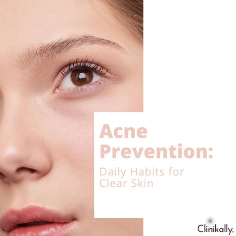 Acne Prevention: Daily Habits for Clear Skin