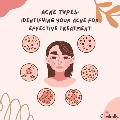 Acne Types: Identifying Your Acne for Effective Treatment