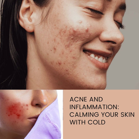 Acne and Inflammation: Calming Your Skin with Cold