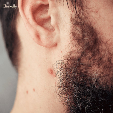 acne on the neck