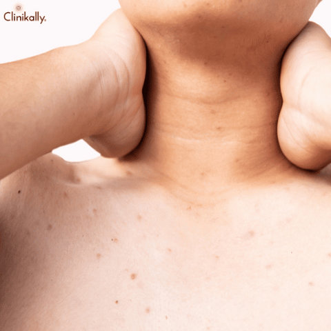 acne on the neck