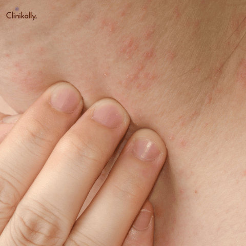 acne on the neck