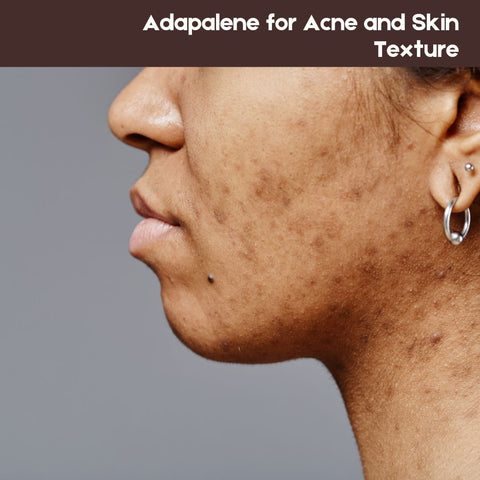 Adapalene for Acne and Skin Texture