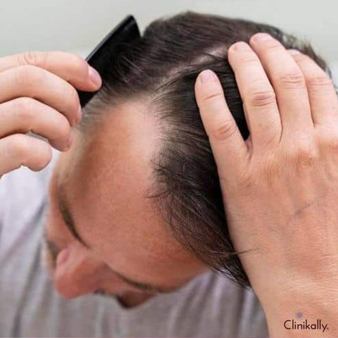Addressing common concerns and misconceptions about applying topical finasteride