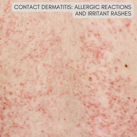 Contact Dermatitis: Allergic Reactions and Irritant Rashes