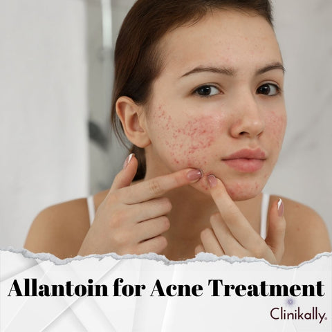 Allantoin for Acne Treatment