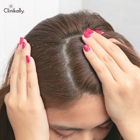 Aloe Vera for hair growth and dandruff control