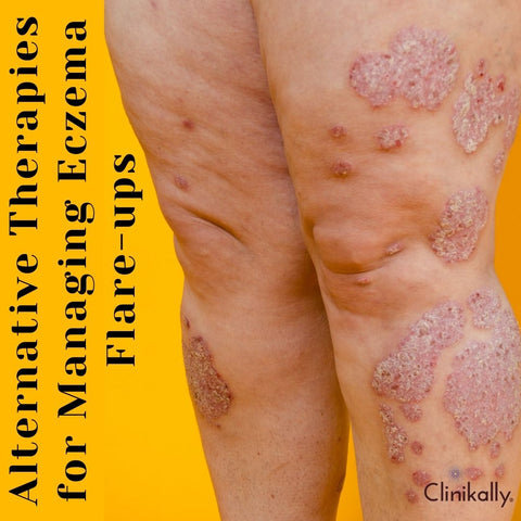 Alternative Therapies for Managing Eczema Flare-ups