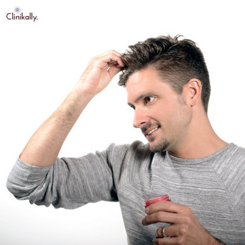 androgenetic alopecia 