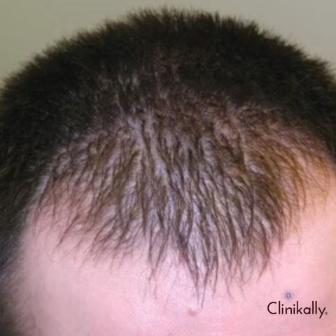 Assessing the Journey: Tracking Your Finasteride Treatment Progress