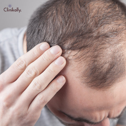 Exploring the Link Between Saw Palmetto and Hair Loss Myth or Reality