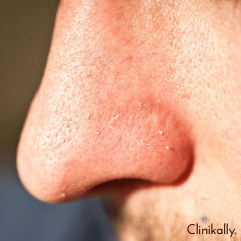 Clogged pores and breakouts