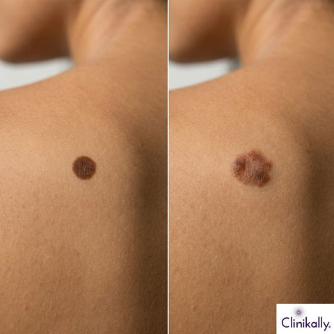 Beauty Marks vs Moles: Key Differences