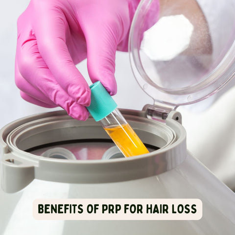 Benefits of PRP for Hair Loss