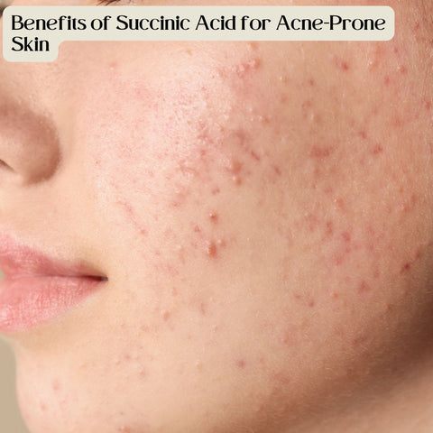 Benefits of Succinic Acid for Acne-Prone Skin