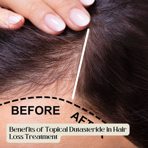 Benefits of Topical Dutasteride in Hair Loss Treatment