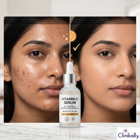 Before and after results of vitamin C serum for oily acne-prone skin