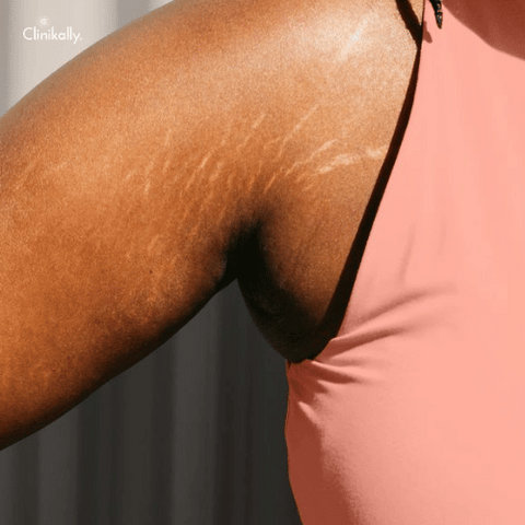 Do stretch marks go away?