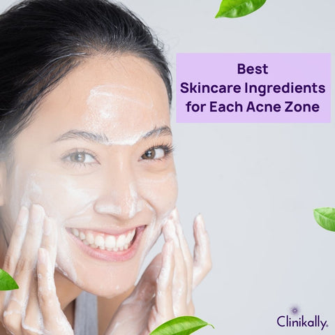Best Skincare Ingredients for Each Acne Zone