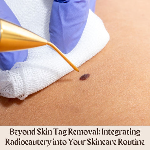 Beyond Skin Tag Removal: Integrating Radiocautery into Your Skincare Routine
