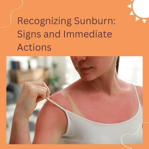 Recognizing Sunburn: Signs and Immediate Actions