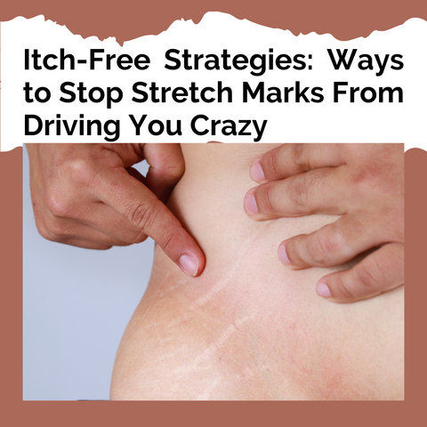 Itch-Free Strategies: Ways to Stop Stretch Marks From Driving You Crazy