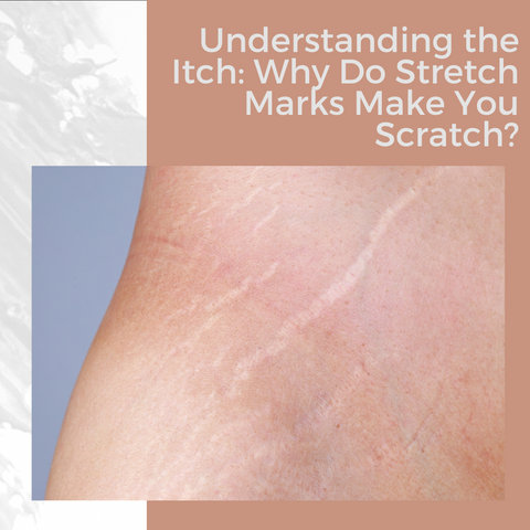 Understanding the Itch: Why Do Stretch Marks Make You Scratch?